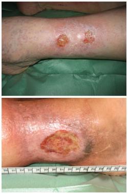 Enfermedades &uacute;lceras venosas - Especialista en Medicina Vascular y Angiolog&iacute;a - Dra. Maya Gracia Graells