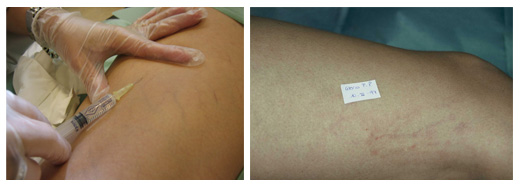 Tratamiento y prevención arañas vasculares o telangiectasias Tratamiento y prevención arañas vasculares o telangiectasias