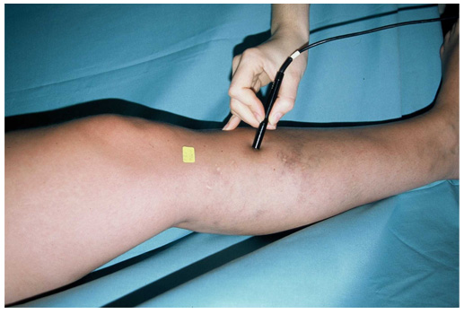doppler continuo para el diagnostico en varices doppler continuo para el diagnostico en varices