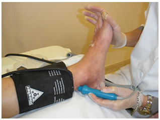 Doppler de transiluminacion para el diagnostico de las varices Doppler de transiluminacion para el diagnostico de las varices