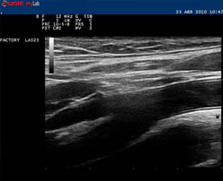 Imagen Ecodoppler venoso Imagen Ecodoppler venoso