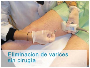 Tratamiento no quirúrgico de las varices de extremidades inferiores