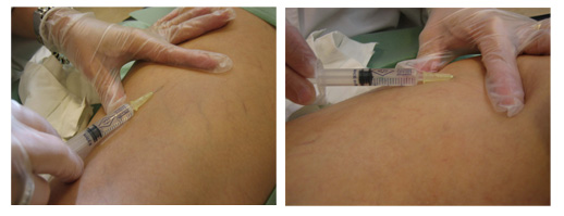excleroterapia, tratamiento contra las varices excleroterapia, tratamiento contra las varices