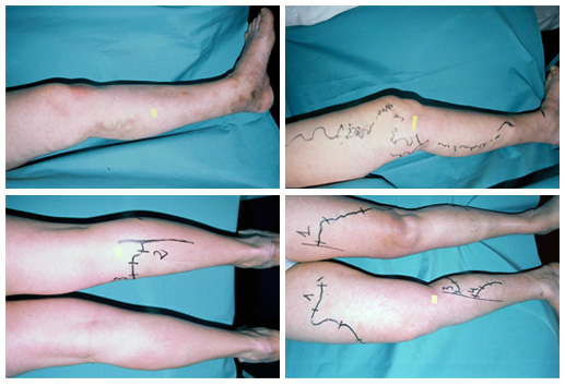 Que son las varices y como tratarlas Que son las varices y como tratarlas