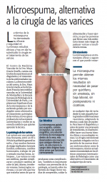 Microespuma, alternativa a la cirugía de las varices Microespuma, alternativa a la cirugía de las varices