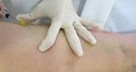 VARICES SIN CIRUGIA. Esclerosis varices VARICES SIN CIRUGIA. Esclerosis varices